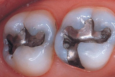 Amalgam Removal
