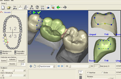 Smile Design