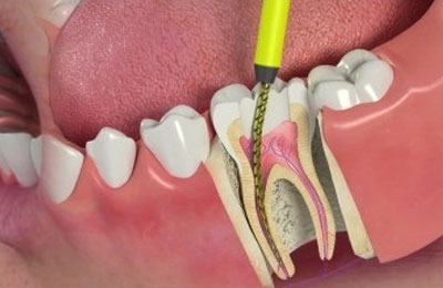 Root Canal Treatment