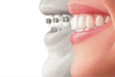 INVISALIGN®